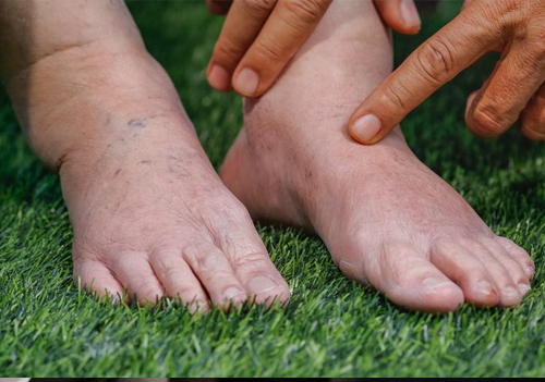 Poor Blood Circulation